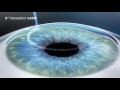 Лазерная коррекция зрения - эволюция