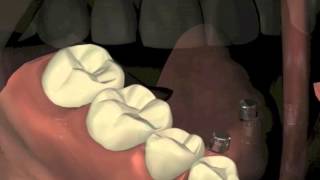 Details Mini Dental Implants (MDL) News