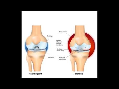 Video: Was Sind Die Immunologischen Konsequenzen Des Langfristigen Einsatzes Biologischer Therapien Bei Juveniler Idiopathischer Arthritis?