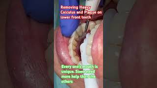 Removing Heavy Built-up of Calculus and Plaque on Lower Teeth shortsfeed