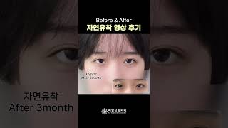 [PR성형외과] 자연유착 영상후기