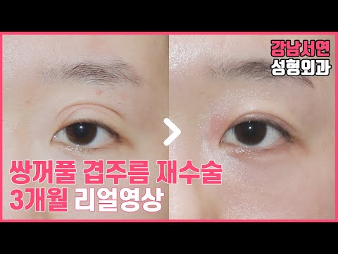 쌍꺼풀 겹주름 없애기, 쌍꺼풀 재수술, 눈매교정 재수술(feat.강남서연성형외과)