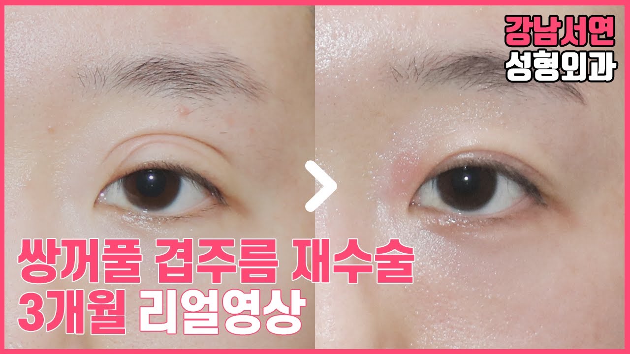 [Ганнам Сөён Гоо Сайхны Мэс Заслын Эмнэлэг] Давхрааны олон нугалааг засах, Давхрааны нөхөн мэс засал, Нүдний хэлбэр засах нөхөн мэс засал (Ганнам Сөён Гоо Сайхны Мэс Заслын Эмнэлэг)