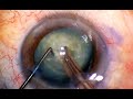 Phaco chop mastery horizontal and vertical for safe cataract surgery