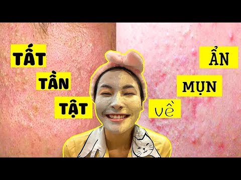 Trị sạch mụn ẩn mà không cần nặn mụn !👍