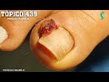 O SUPER GRANULOMA ( NAIL'S LOVERS )#PODOLOGOMAURELIO #PODOLOGIA#UNHAENCRAVADA