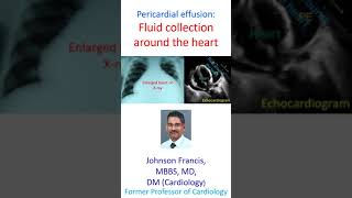 Pericardial effusion: Fluid collection around the heart