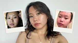 my acne journey ❤️‍🩹 living with acne, insecurities & how to cope by sruh tran 461 views 8 months ago 15 minutes