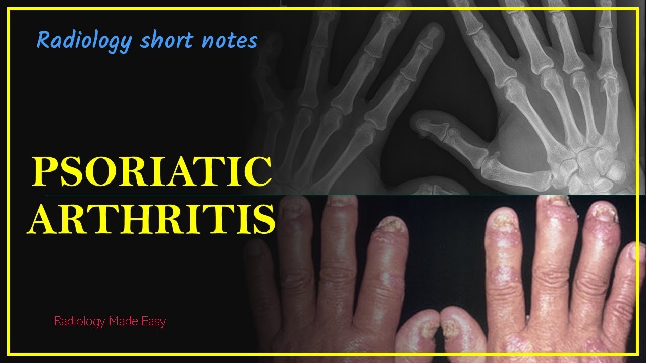psoriatic arthritis radiology
