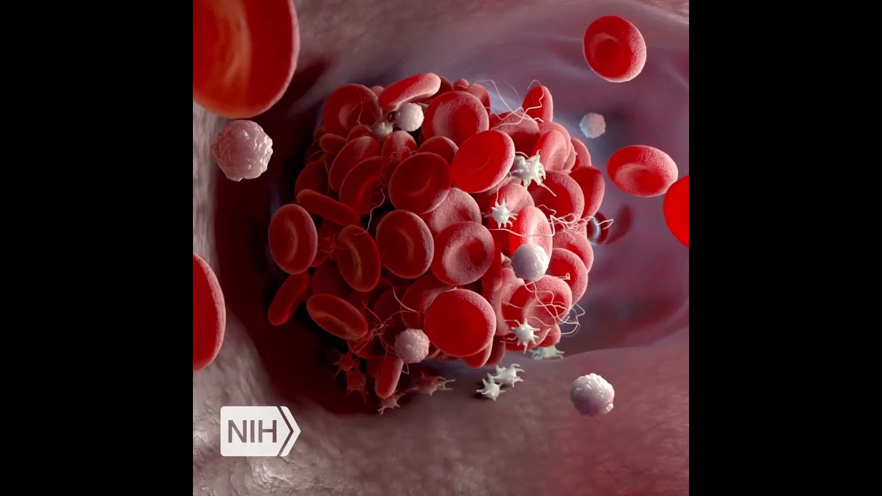 NIH Clinical Trials: #COVID19 ACTIV-4 Antithrombotics