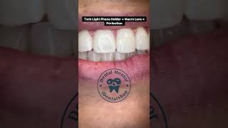 Smartphone Dental Photography Gadgets 🫡