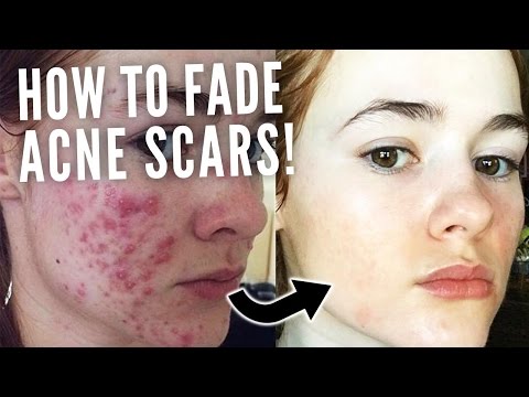 HOW TO FADE ACNE SCARS