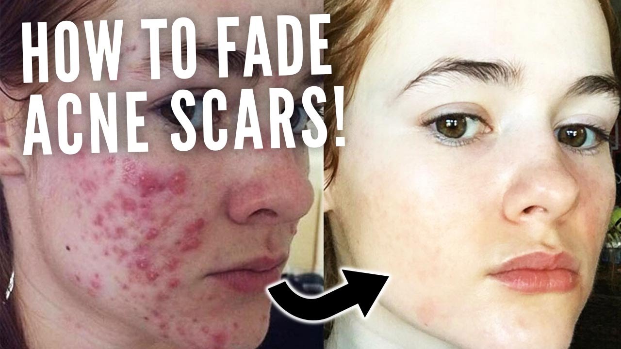 How Long Does It Take For Acne Scars To Fade