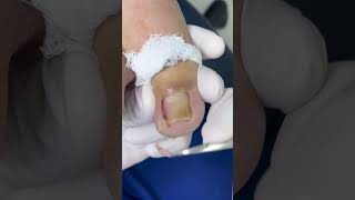 SOLUCIÓN DEFINITIVA PARA UÑAS ENCARNADAS! #satisfying #ingrown_toenail_surgery