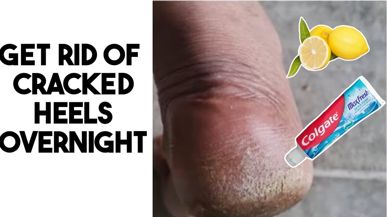Cracked Skin Removal Feet | TikTok