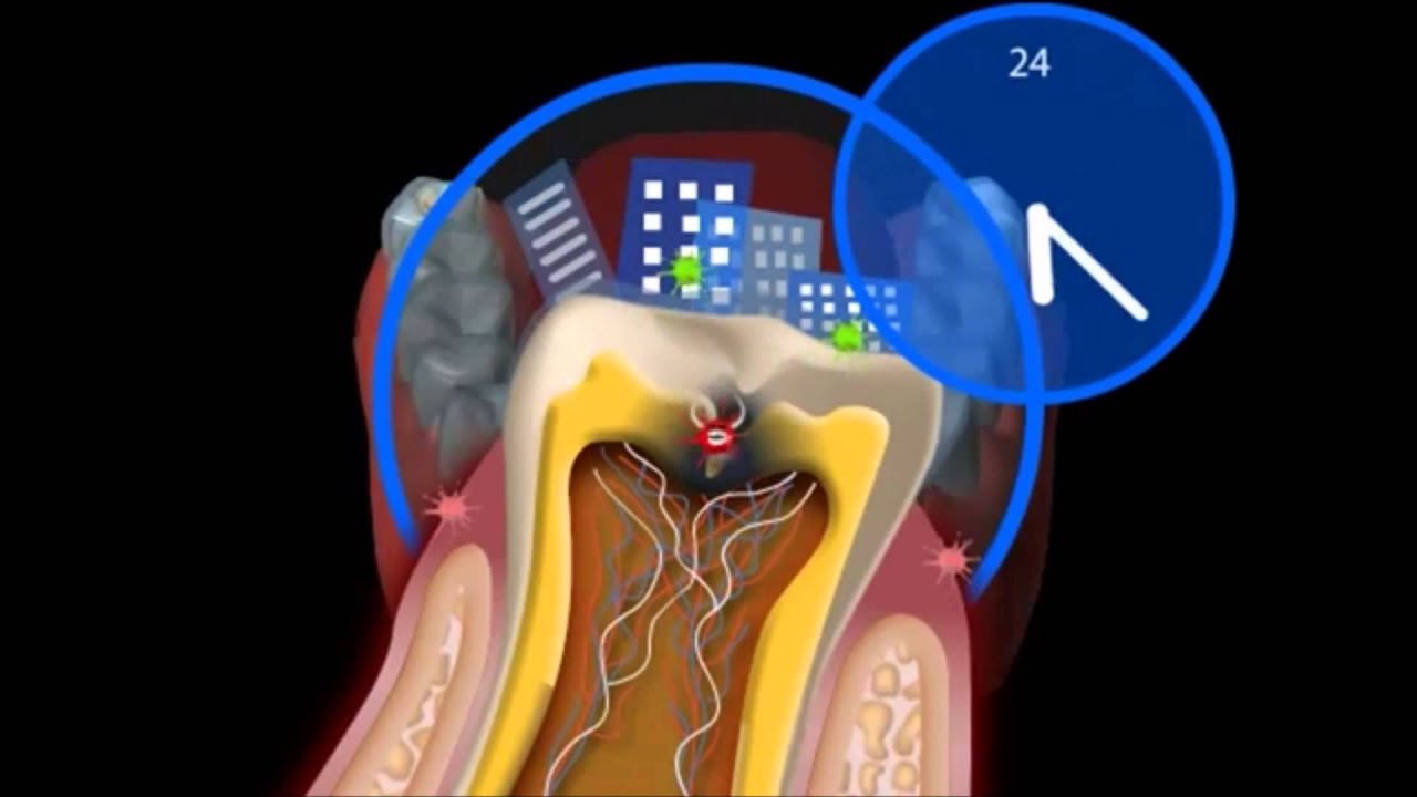 Что такое кариес Как лечить кариес Терапевтическая стоматология