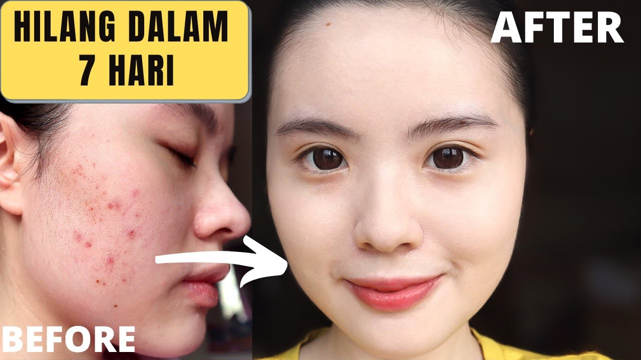 Cara Paling Cepat Menghilangkan Bekas Jerawat (DALAM 7 HARI) - YouTube