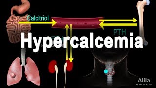 Hypercalcemia - Too Much Calcium, Animation