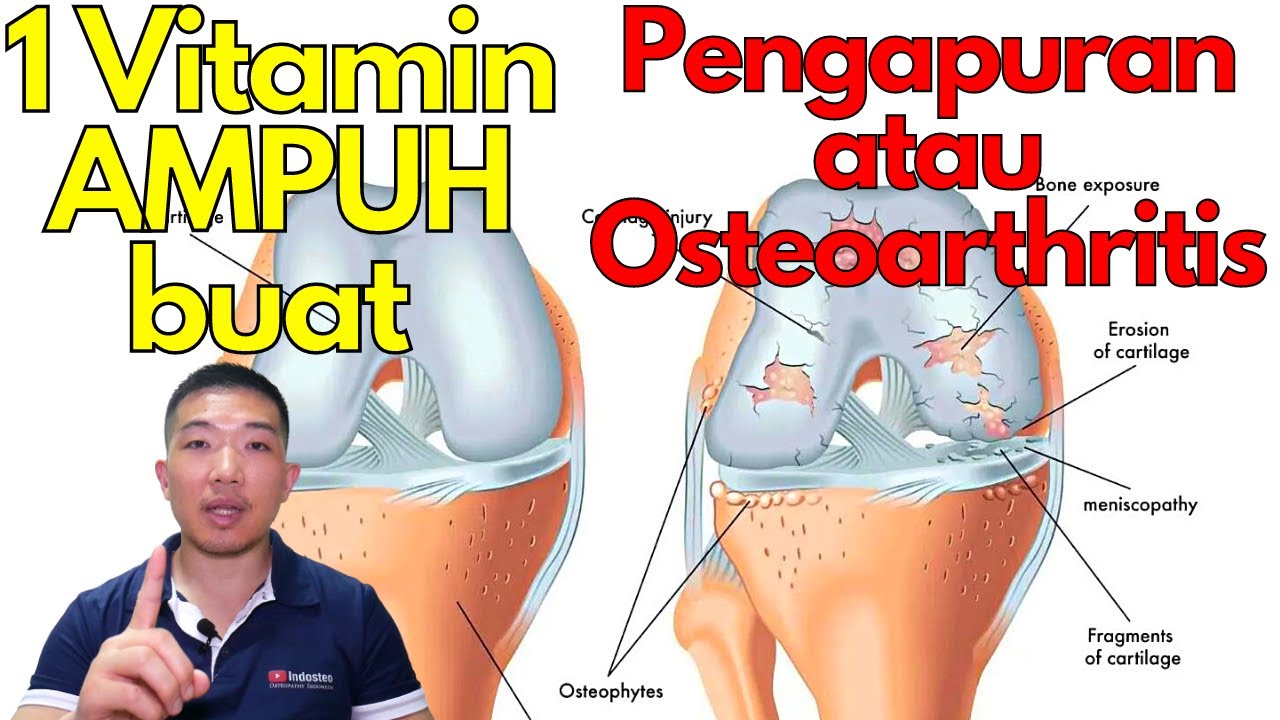 1 Vitamin AMPUH buat pengapuran / osteoarthritis !