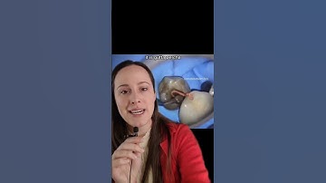 Tooth Worm Or Gutta Percha #dentist #cavities #dental #health #teeth #toothcare