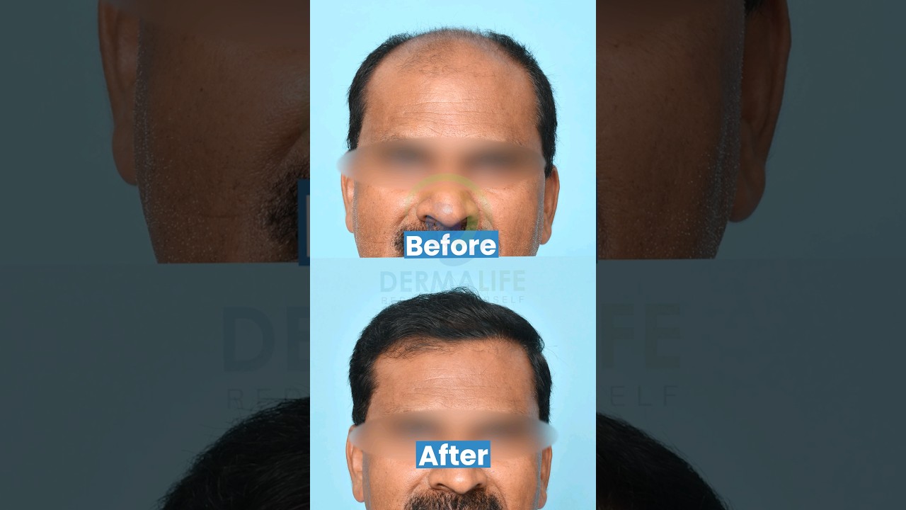 Bald to Bold - 11 Months Journey of Hair Transplant | 6000 Grafts with Boosted FUE Technique