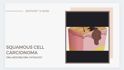 Moderately to poorly differentiated squamous cell carcinoma