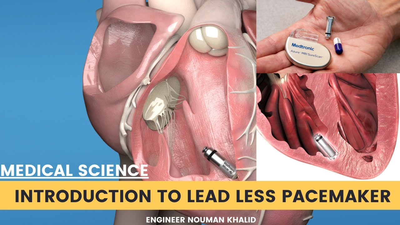 Introduction To Leadless Pacemaker And Comparison With Conventional Introduction To Leadless Pacemaker And Comparison With Conventional