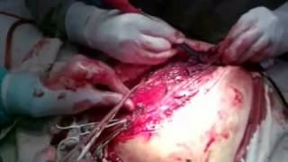 хирургическая инфекция реферат