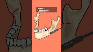 BSSO, Bilateral Sagittal Split Osteotomy Animation #drteeth #dentistry