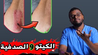 كيف تتغلب على الصدفية في سبعة خطوات .. psoriasis