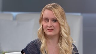 I Need Help Getting a Prosthetic Eye Getting My Prosthetic Eye
