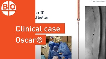 Clinical case: Treatment of a long calcified flush SFA occlusion