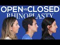 Open v closed rhinoplasty  dr  moustafa mourad  mourad nyc