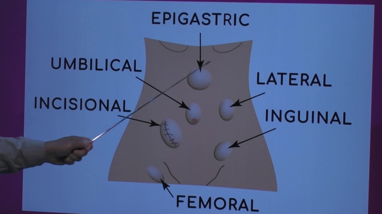 Types Of Hernia Youtube