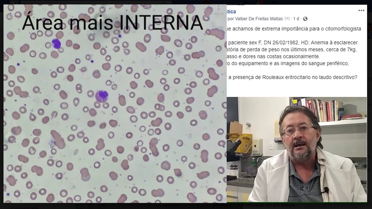 Rouleaux Eritrocitário??? - YouTube
