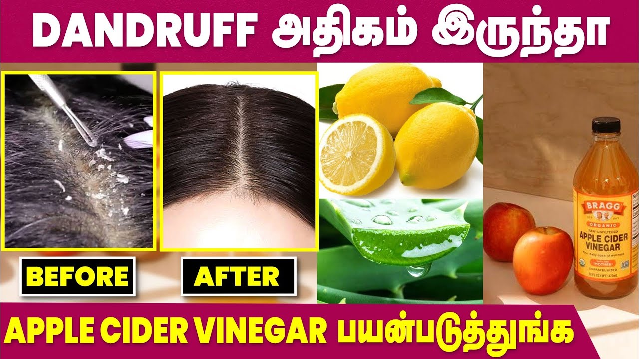 Homemade Hair Pack for Dandruff Apple Cider Vinegar for Hair YouTube