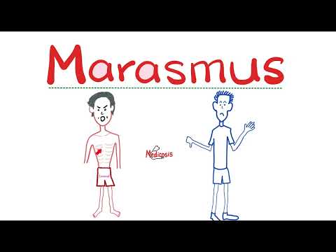 Marasmus - Total Energy Malnutrition - Gastroenterology 