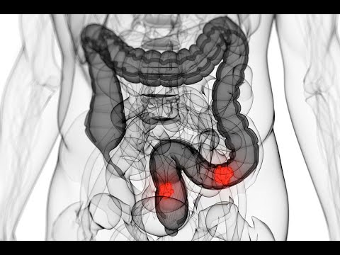 Vídeo: Diarrea Crónica: Opciones De Tratamiento, Síntomas Y Causas