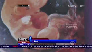 Janin yang Dilahirkan Ganang Ternyata Tumor Teratoma - NET5