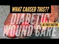 What Caused This? Diabetic Wound Care