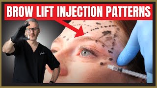 Botox Brow Lift Injection Patterns. Botox Mark-Up Tutorial