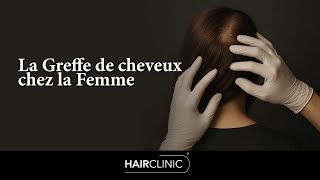 Greffe de cheveux sans rasage pour femme : La solution discrète contre la perte de cheveux