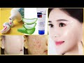 How To Get Clear Perfect Skin Naturally | គ្មានមុនហើយមុខសលឿនទៀត | Face Wash Scrub And Mask At Home