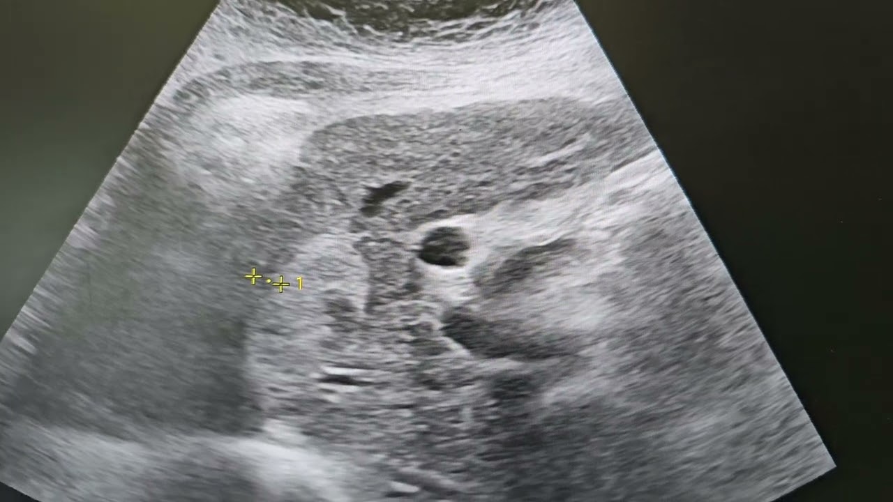 Ung thư gan giống hemangioma.  1 ca thực chiến.  bs Dương Sđt 0399 777 888 - youtube