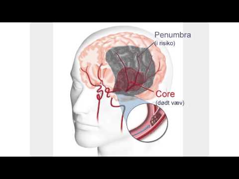 Video: Hvilken del af hjernen er beskadiget af et slagtilfælde?