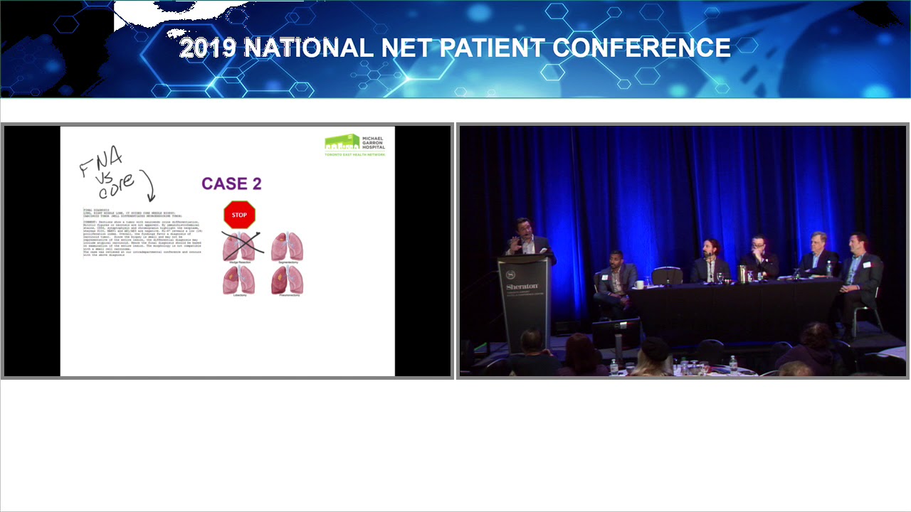 Surgery Lung NETs - Dr. Carmine Simone