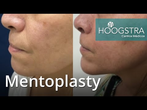 Video: Vad är Mentoplasty?