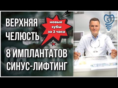 8 имплантатов и синус-лифтинг. Новые зубы за 2 часа. New teeth in 2 hours.