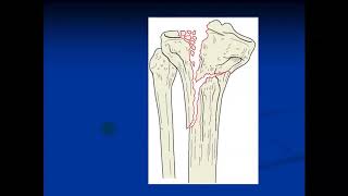 Tibial Plateau Fracture & Fracture Dislocation