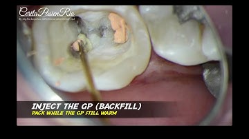 WARM vertical compaction endodontic treatment heated gutta percha eqv obturation